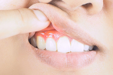 Gum Therapy