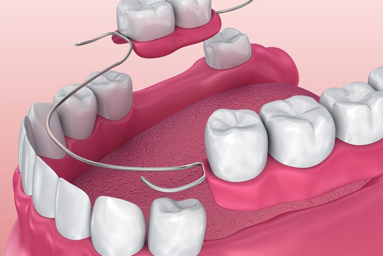 Removable Dentures