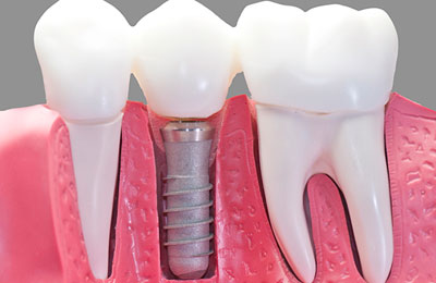 Dental Implants