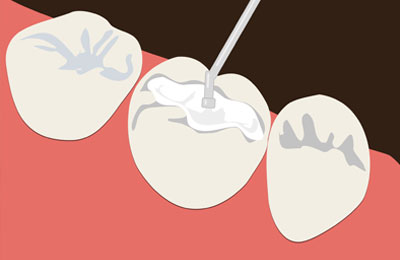 Fillings